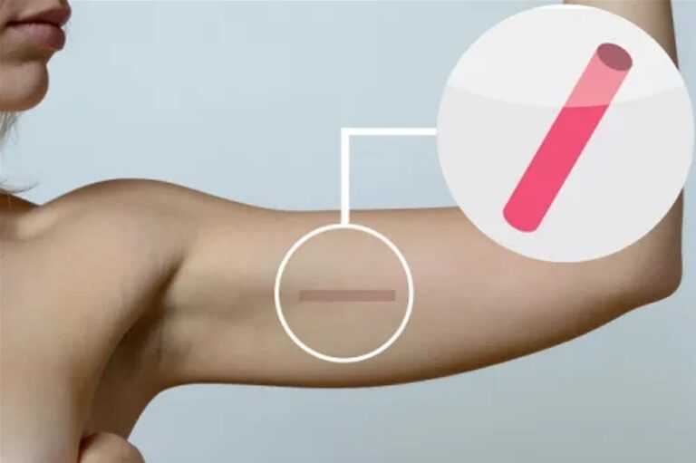 saude-define-criterios-para-fornecimento-de-implante-contraceptivo-de-longa-duracao-pelo-sus